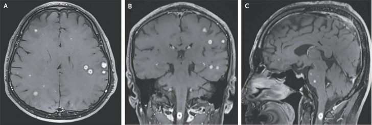 Белые точки на снимке — то самое «звездное небо» | Источник: New England Journal of Medicine