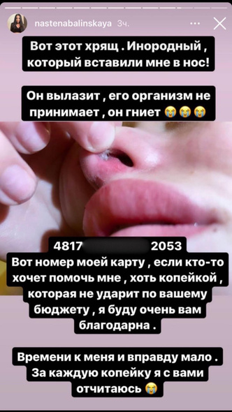 Анастасия Балинская: фото, инстаграм, нос, ринопластика, операция, до и после, сейчас, дом-2