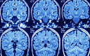 Отсканировали мозг, и все стало понятно: ученые обнаружили отправную точку шизофрении