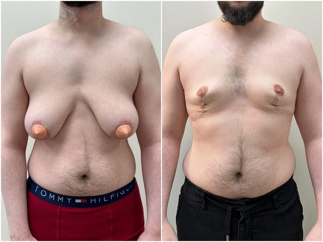Фото мужчины до и после операции. На втором снимке результат спустя 11 месяцев после операции | Источник: Евгений Олейник