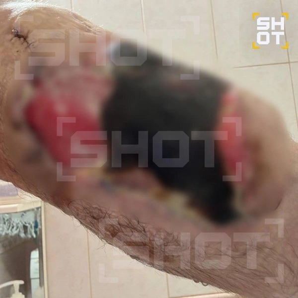 «Руки-Базуки» почернели и гниют: Кирилл Терешин может лишиться конечностей