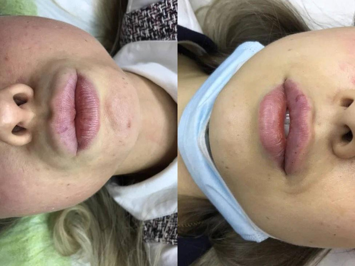 Утиное лицо и усы: 3 вопроса косметологу спасут от этих жутких последствий увеличенных губ