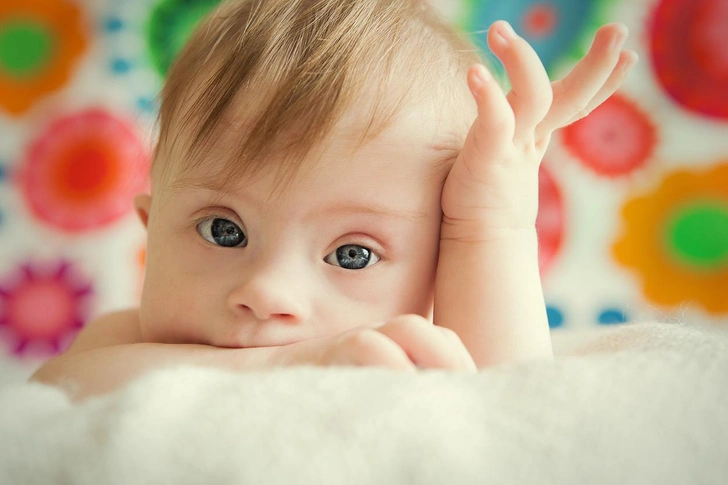 синдром Дауна причины, лечение  | Источник: iStock