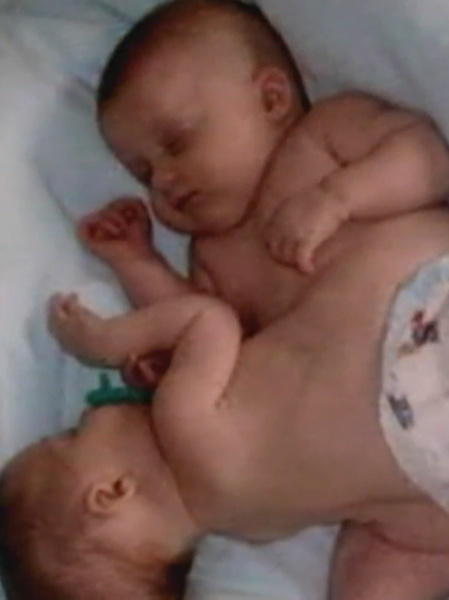 сиамские близнецы, история сиамских близнецов, сиамские близнецы тогда и сейчас, реальная история, история из жизни, как сложилась жизнь сиамских близнецов, что стало с сиамскими близнецами