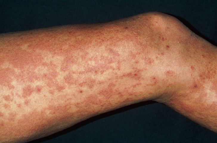 Что такое аллергическая крапивница и как она проявляется на теле человека