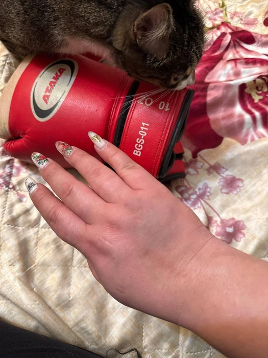 У девушки зафиксировали отек правой кисти | Источник: собеседница НГС