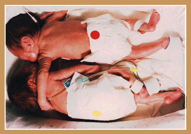Всего одно необычное действие спасло жизнь недоношенным двойняшкам — вы удивитесь