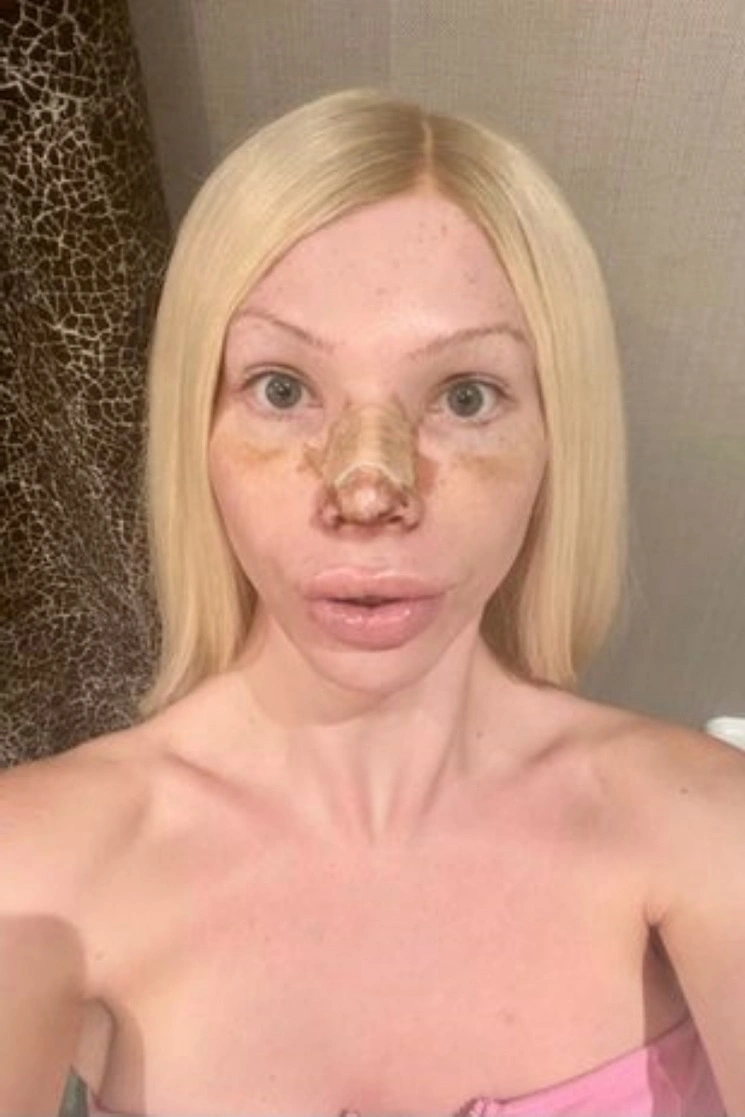 После ринопластики | Источник: theserenasmith / Instagram (деятельность запрещена в РФ)