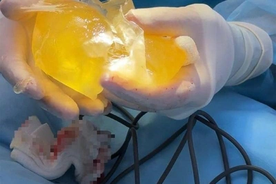 Имплант груди лопнул у уфимки после операции по знакомству