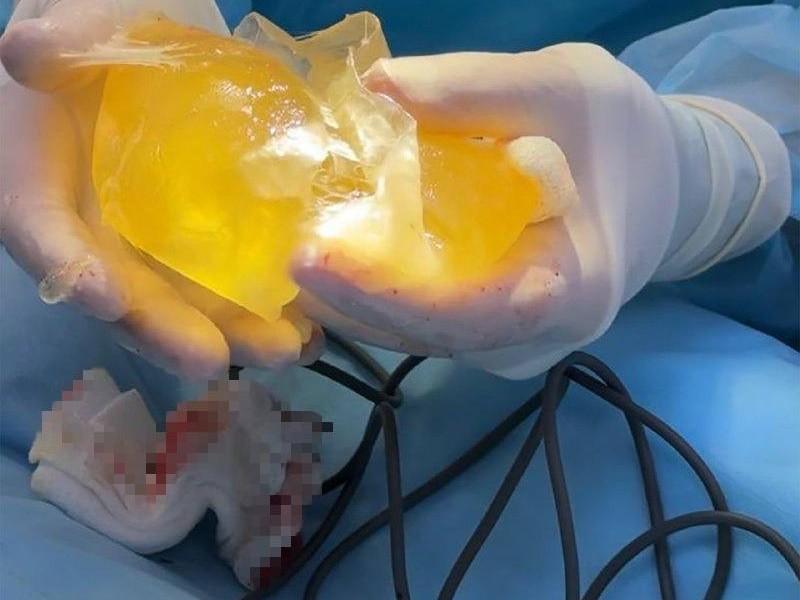 Уфимка увеличила грудь по знакомству — в итоге имплант лопнул