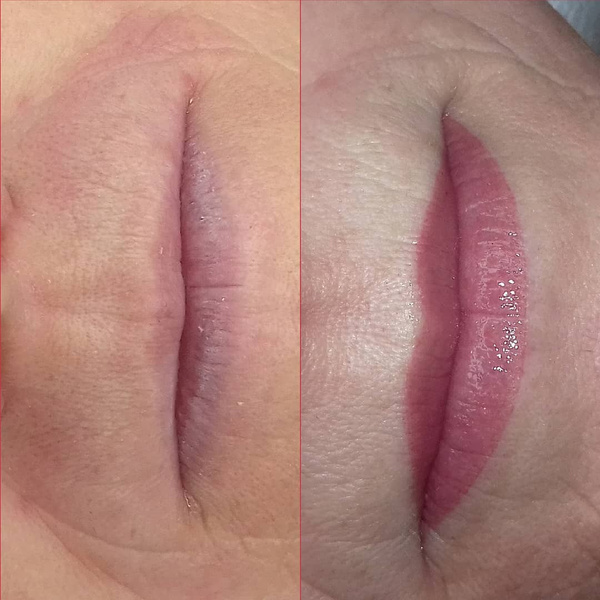 Увеличились малые губы. Коррекция ассиметричных губ. Увеличились малые губы. Увеличились малые губы. Увеличились малые губы.