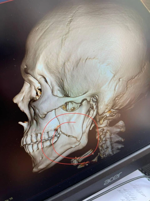 Из-за сломанной челюсти Вадиму пришлось питаться через трубочку | Источник: Didenko.katerina / Telegram