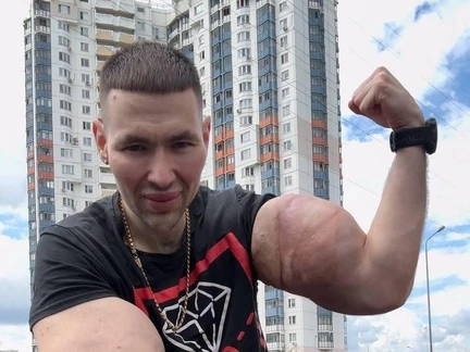 Кирилл Терешин «Руки-базуки» удалил синтол из бицепсов: «Есть вероятность, что я остался бы без руки»
