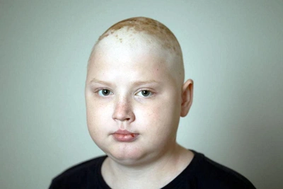Teen with Brain Cancer Urgently Needs Proton Therapy