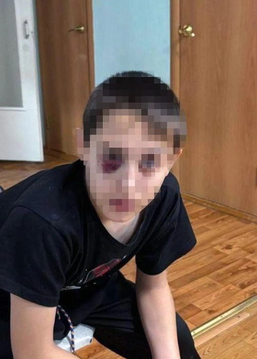 Лицо мальчика мы вынуждены размыть, но и так видно, какие синяки у него под глазами | Источник: телеграм-канал «Воронцова вещает»