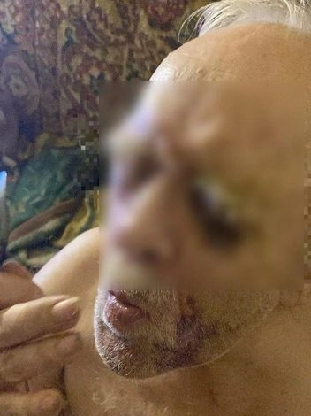 После того как муж Светланы сбрил Александру Васильевичу бороду, соседи увидели, что пенсионер весь в синяках | Источник: Светлана Голоюхова