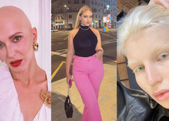 Альбинизм и заикание: как люди с физическими особенностями стали популярными в TikTok