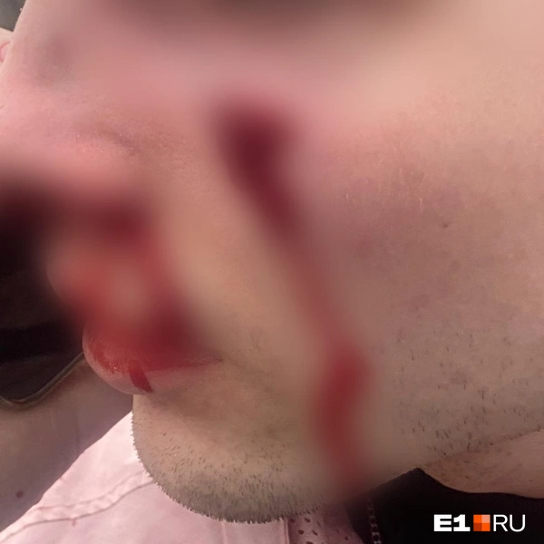 После дорожного конфликта у парня сломан нос, сотрясение мозга, повреждены глаз и щека | Источник: читательница E1.RU