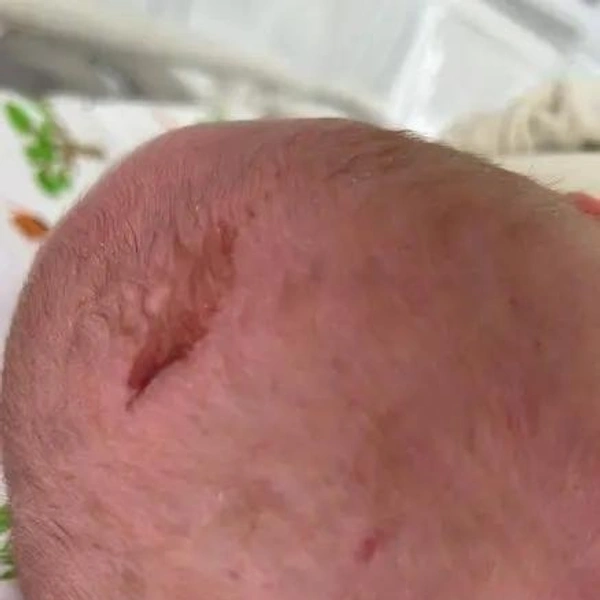 Вот с такими порезами на головках выписывались младенцы из роддома в Новокузнецке | Источник: NGS42.ru