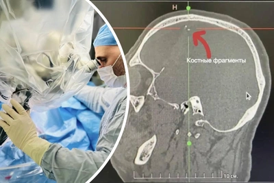 Пациент с пробитым черепом сутки не обращался к врачам