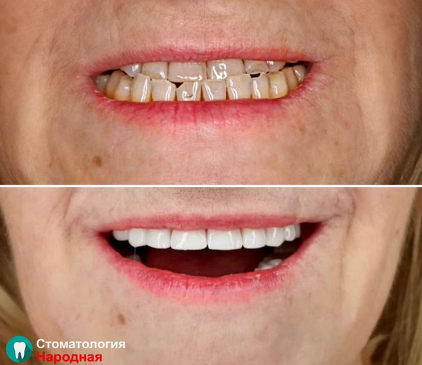 Виниры на зубы фото до и после