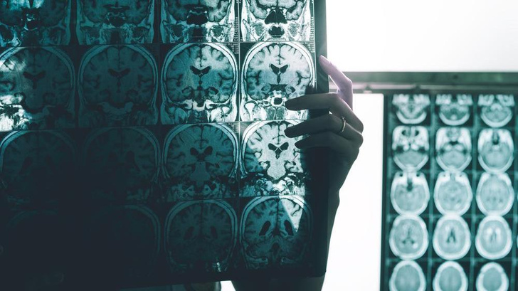 19-летний китаец стал самым молодым пациентом в мире с болезнью Альцгеймера