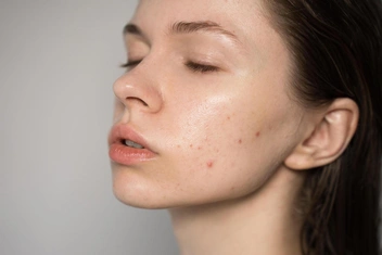 Зумеры нашли оригинальный способ скрыть прыщи — такой хитрости можно только позавидовать