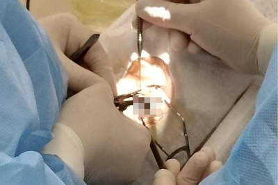 Воронежец 20 лет жил с косоглазием, но решился на операцию