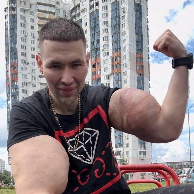 Кирилл Терешин «Руки-базуки» удалил синтол из бицепсов: «Есть вероятность, что я остался бы без руки»