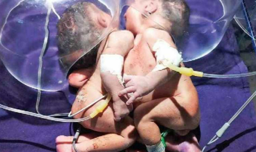 Сиамские близнецы с одним сердцем на двоих родились в Индии