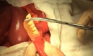 Петербургские хирурги прооперировали пациента, проглотившего вставную челюсть