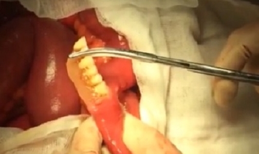 Петербургские хирурги прооперировали пациента, проглотившего вставную челюсть