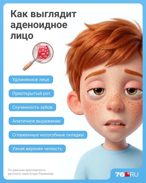 Детский лор рассказал, как выглядит аденоидное лицо | Источник: Евгения Бикунова / Городские порталы 