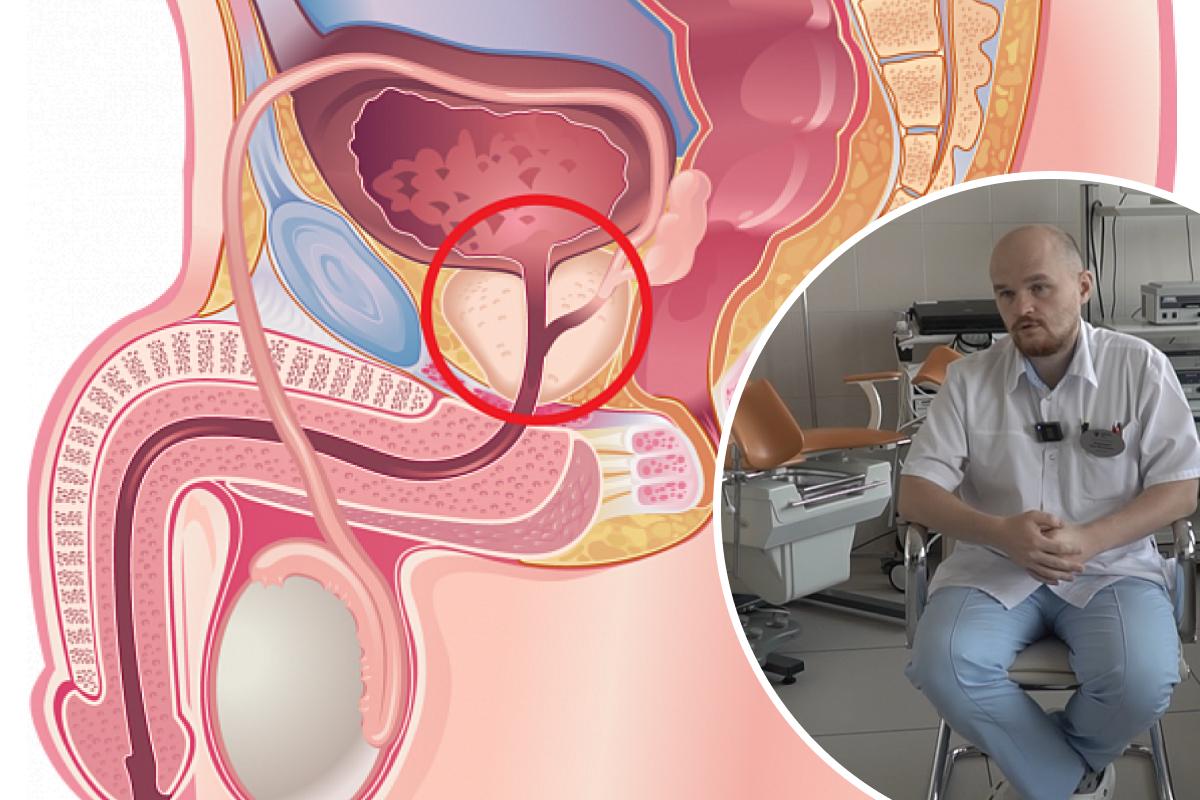Уролог рассказал, чем опасно воспаление простаты - 7 сентября 2023 - ЧИТА.ру