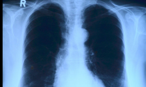 Минздрав: Во время и после ковида может развиться туберкулез