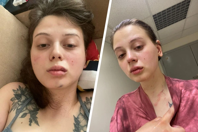 Разбитая губа, подбитый подбородок, кровоподтеки на шее — этого не достаточно для возбуждения уголовного дела | Источник: Валерия Васильева