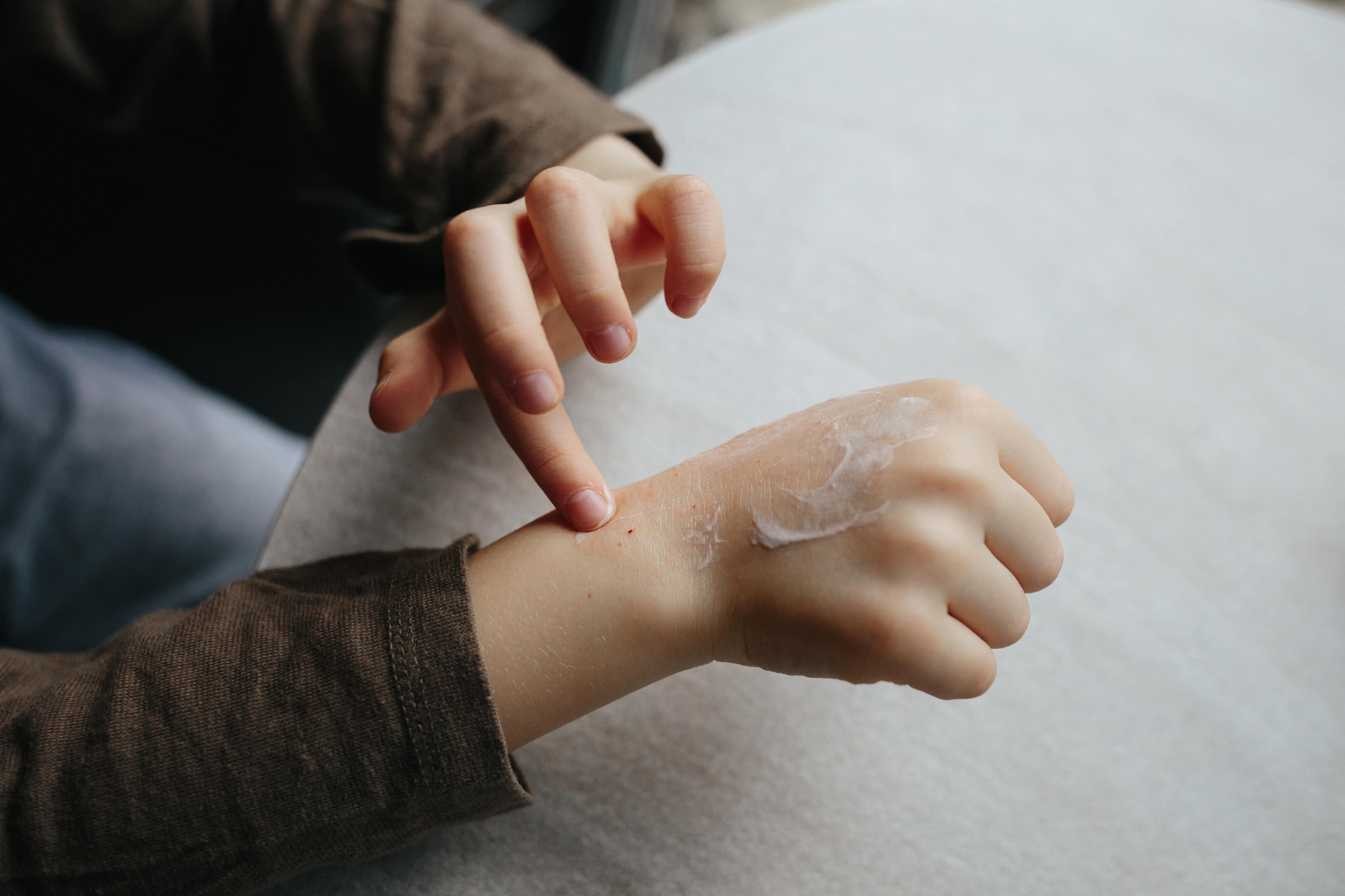 Что делать, если у вашего ребенка облазит кожа на пальцах рук и ног? Возможные заболевания.