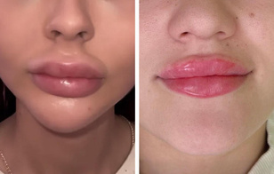 Надутые губы: как миграция филлера выглядит на самом деле — 5 жутких фото