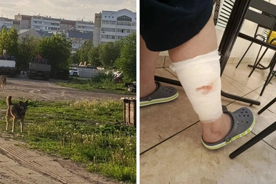 У мальчика из Перми после нападения овчарки развился некроз