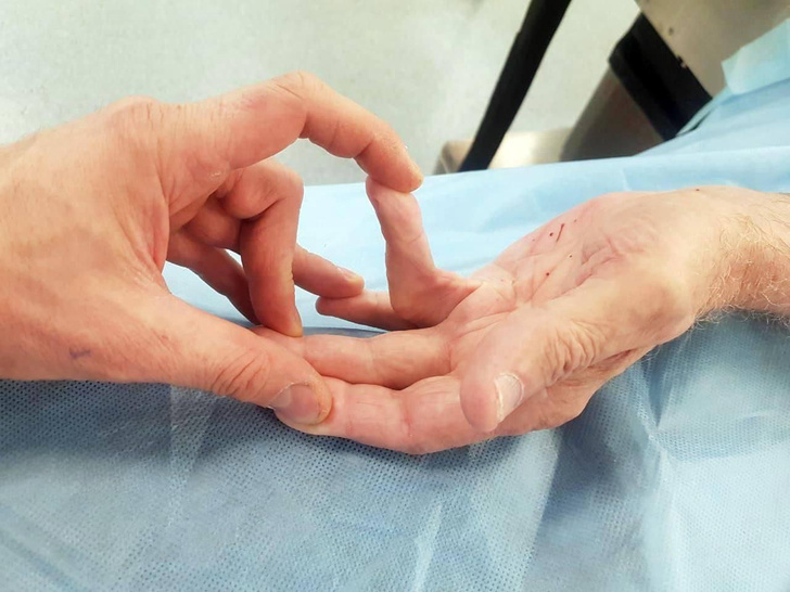 В Подмосковье врачи помогли мужчине с «болезнью викингов» разогнуть безымянный палец