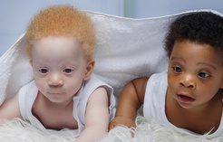 Как сейчас выглядят братья-близнецы с разным цветом кожи Дэвид и Дэниел