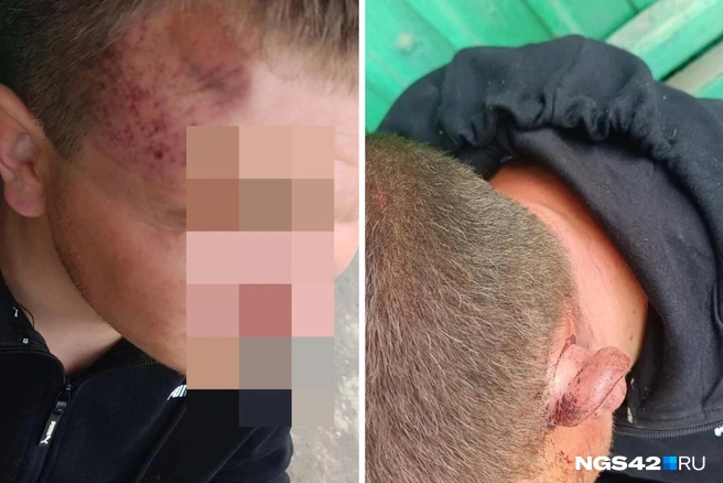Другу мужчины рассекли голову и сломали нос, у него самого — рана от пули | Источник: редакция NGS42.RU