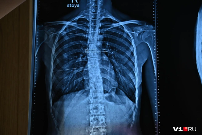 Обычный рентген без сульфата бария не всегда позволяет увидеть то, что нужно врачу | Источник: Елена Буйвол / VLADIVOSTOK1.RU