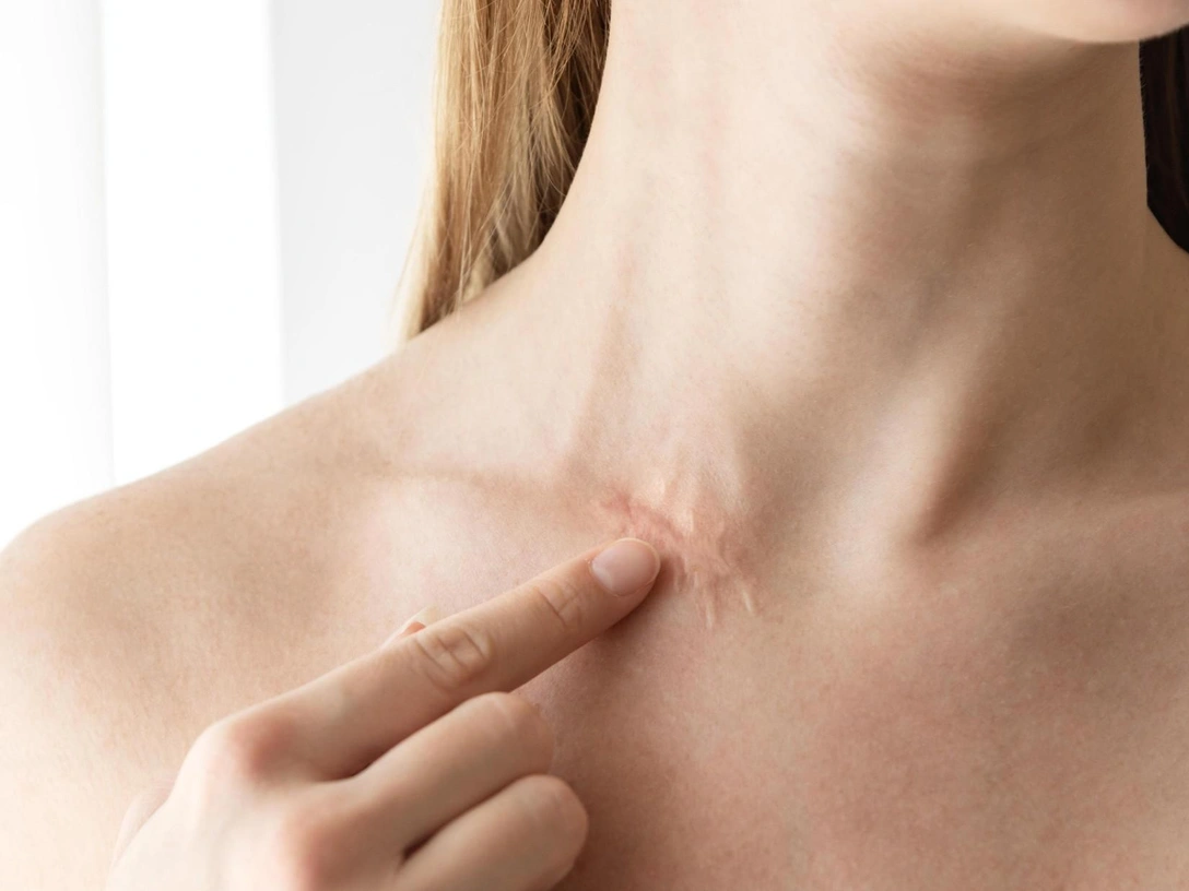 Как шрамы и рубцы «ломают» тело в неожиданных местах | marieclaire.ru