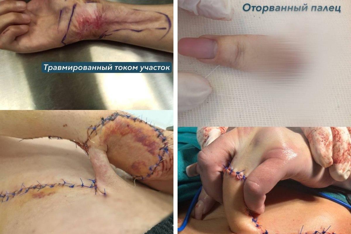 В Татарстане девушка мыла подоконник и оторвала себе палец. Часть фаланги спасли, пришив к животу