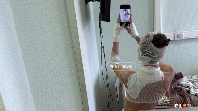 У девушки обожжены руки, лицо, плечи и шея | Источник: читатель E1.RU