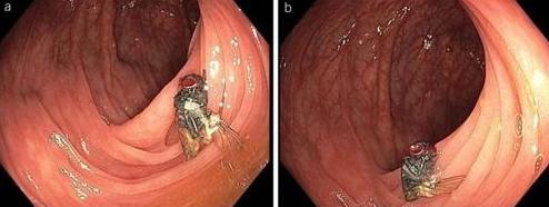 Источник: American Journal of Gastroenterology