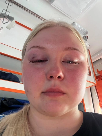 Девушку ударили в лицо, оно сильно опухло | Источник: Предоставлено Анастасией