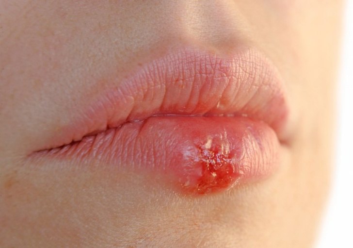 Лечение опухоли на губах