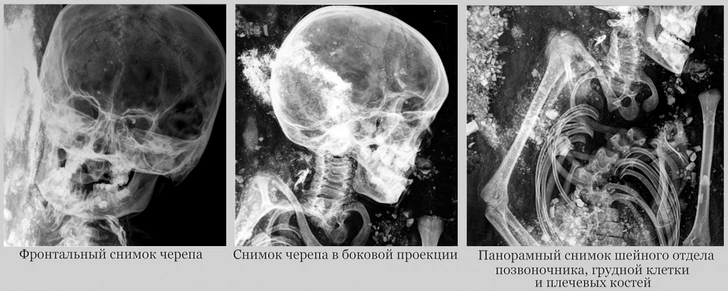 Ученые назвали возраст гибели жившей 2600 лет назад скифской девочки-амазонки